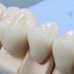 косметическое восстановление анатомической формы зуба