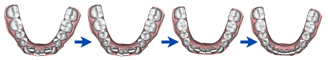 Процесс коррекции зубного ряда