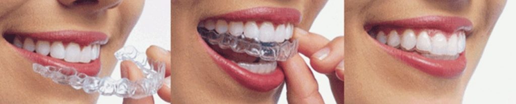 Процесс коррекции зубного ряда 3D Smile