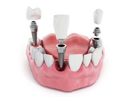 Имплантация зубов в стоматологи Без боли